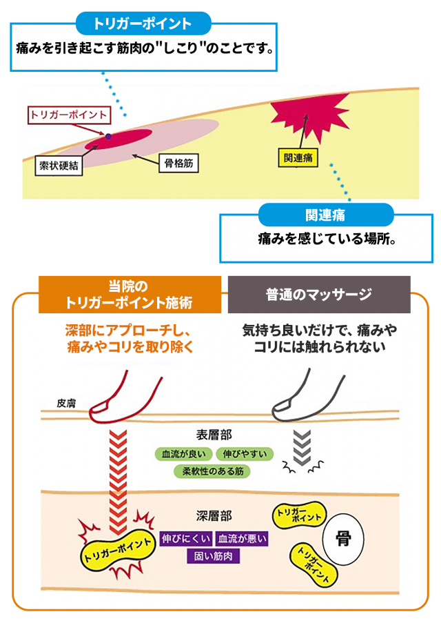 トリガーポイントの説明